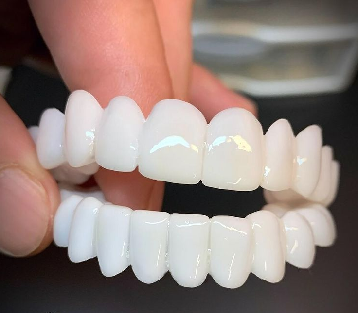 Facettes Dentaires DentAlign – Ajustement Naturel et Confortable, Matériau Composite Durable, Amélioration Rapide du Sourire 0